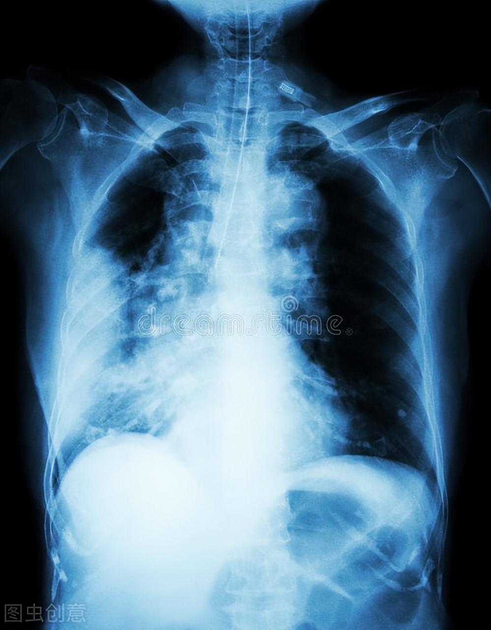 最新肺炎病毒感染,一场自然美景的探险之旅,寻找内心的平和与宁静