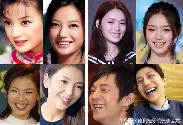 🌟明星都是假牙吗?揭秘牙齿背后的真相✨