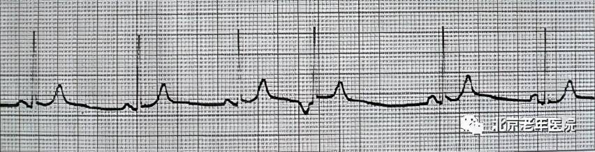 最新早搏吧,带你领略心跳的节奏!